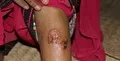 The initial effect of a Sandfly bite