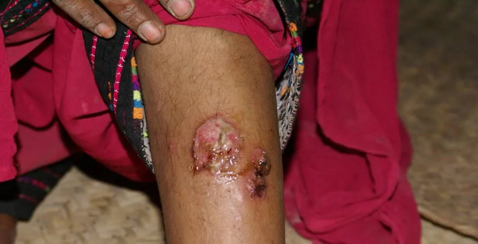 The initial effect of a Sandfly bite